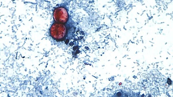 This undated photo taken through a microscope provided by the CDC shows Cyclospora cayetanensis oocysts found in a fresh stool sample which had been prepared with a formalin solution and stained with safranin. (CDC via AP)
