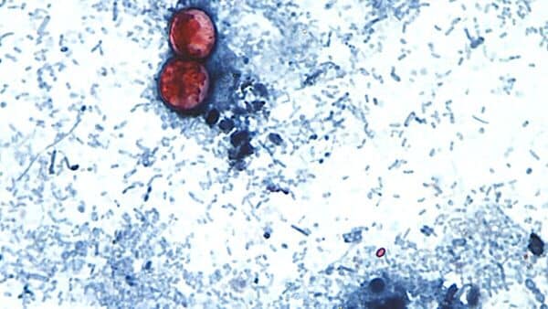 This undated photo taken through a microscope provided by the CDC shows Cyclospora cayetanensis oocysts found in a fresh stool sample which had been prepared with a formalin solution and stained with safranin. (CDC via AP)