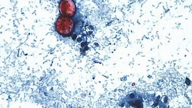 FILE - This undated photo taken through a microscope provided by the CDC shows Cyclospora cayetanensis oocysts found in a fresh stool sample which had been prepared with a formalin solution and stained with safranin. (CDC via AP, File)